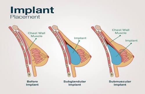 Schéma implantace prsních implantátů pod a nad svalem