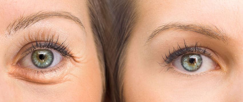 Photo avant et après d'une blépharoplastie